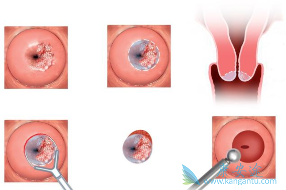 宫颈癌晚期能活多久 宫颈癌晚期能活多久