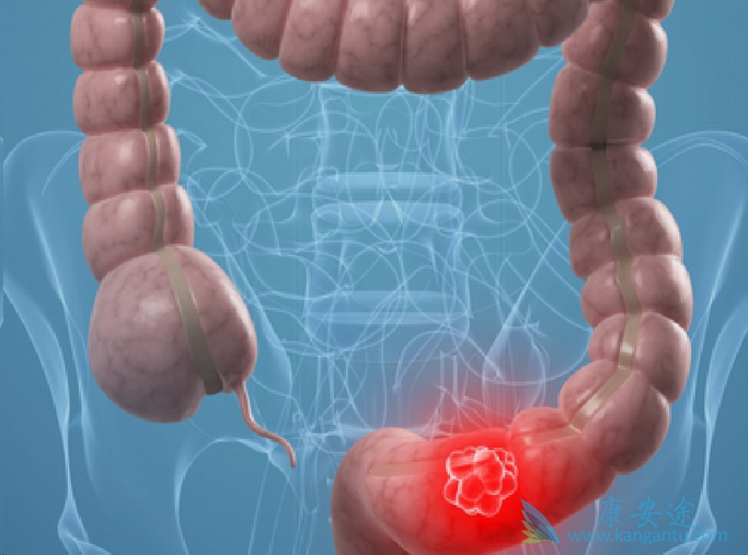 结直肠癌 结直肠癌