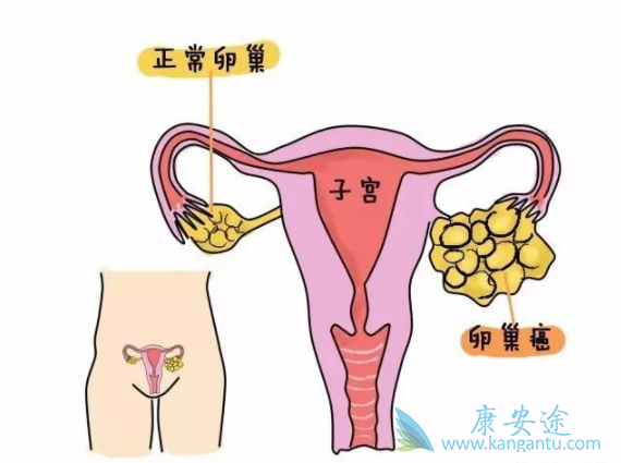 卵巢癌分期 卵巢癌分期