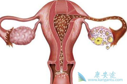 卵巢肿瘤 卵巢肿瘤