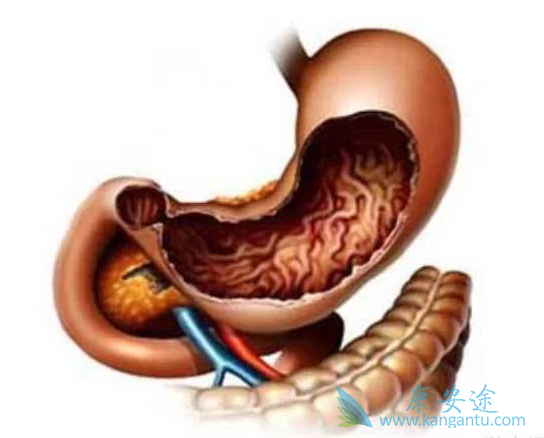 胃肠间质瘤 胃肠间质瘤