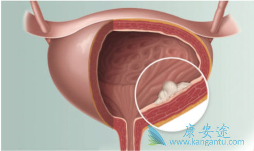 膀胱癌的早期症状 膀胱癌的早期症状