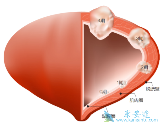 膀胱癌晚期 膀胱癌晚期