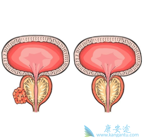前列腺癌骨转移 前列腺癌骨转移