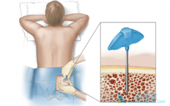 ��Ѫ��������ֲ�ɹ��ʶ��٣��б�Ҫ��ֲ��