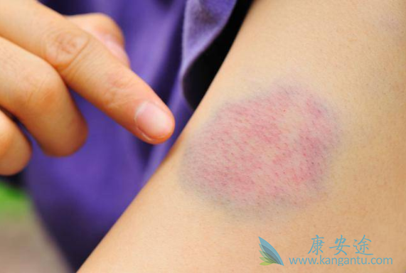 白血病前兆 白血病前兆