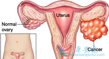 卵巢癌晚期 卵巢癌晚期