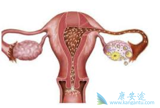 卵巢癌晚期 卵巢癌晚期
