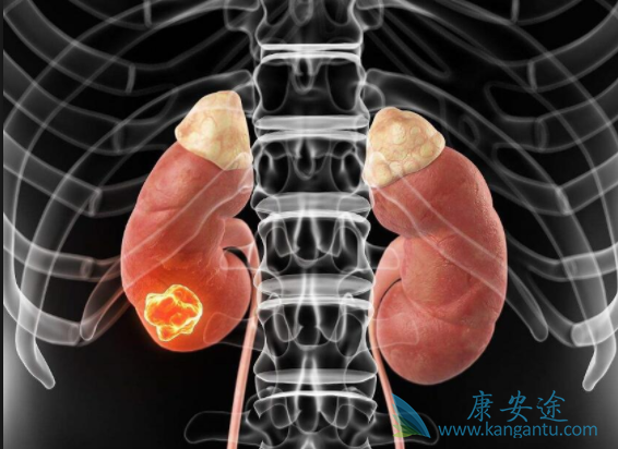晚期肾癌 晚期肾癌