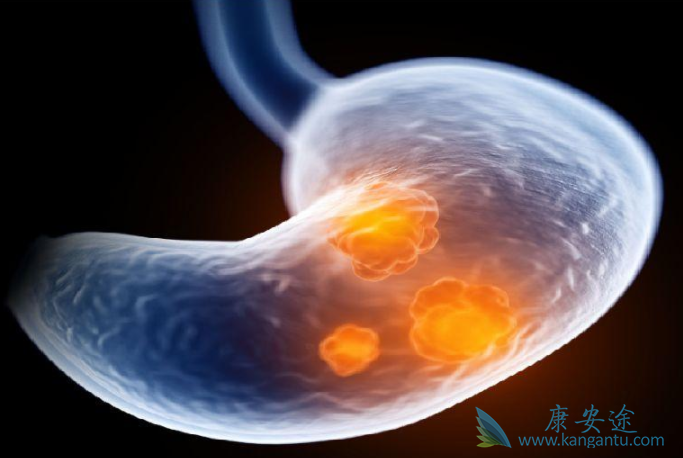 胃癌新药 胃癌新药