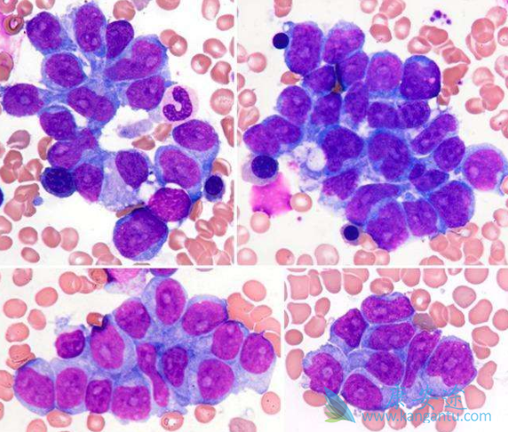 多发性骨髓瘤治疗 多发性骨髓瘤治疗