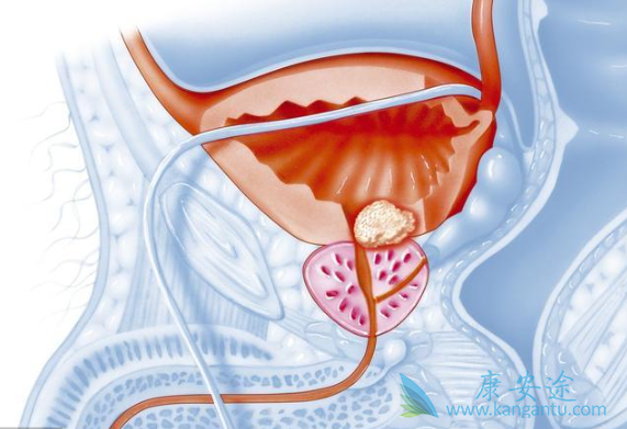 前列腺癌症 前列腺癌症