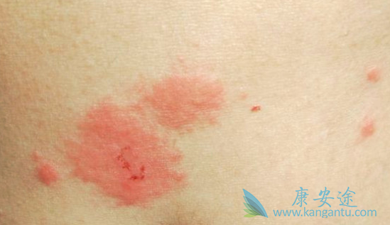 皮疹怎么治疗 皮疹怎么治疗