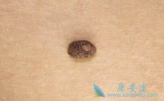 Ϊʲô˵��ɫ������Ƥ�������ж��Գ̶���ߵ�������������Щ֢״��