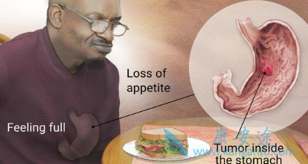 晚期胃癌 晚期胃癌