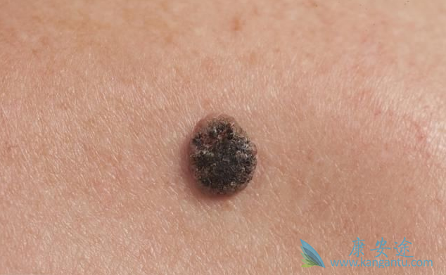 黑色素瘤 黑色素瘤