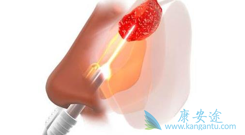 鼻咽癌存活率 鼻咽癌存活率