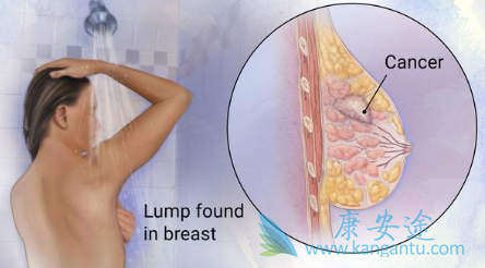乳腺癌复发 乳腺癌复发