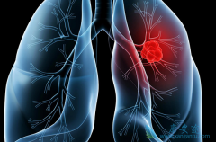 EGFR-TKI�ͷ��������ӷ�Сϸ���ΰ����ߵĻ�����