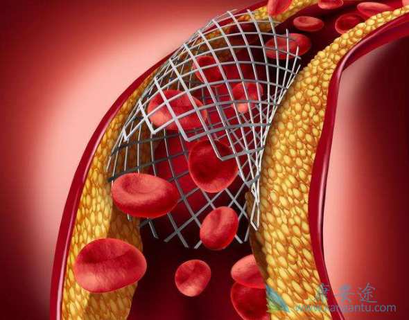 心脏支架手术后 心脏支架手术后