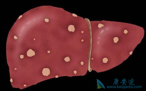 原发性肝癌 原发性肝癌