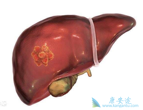 原发性肝癌 原发性肝癌