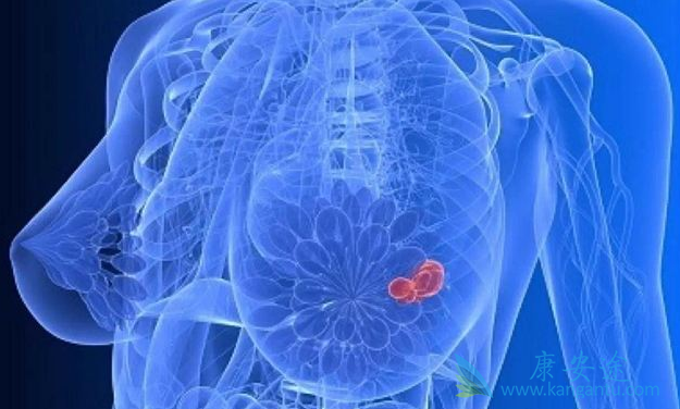 乳腺癌的原因 乳腺癌的原因