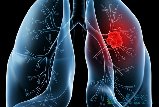 肺癌晚期 肺癌晚期