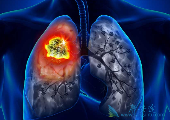 肺癌化疗 肺癌化疗