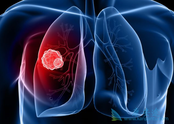 小细胞肺癌 小细胞肺癌