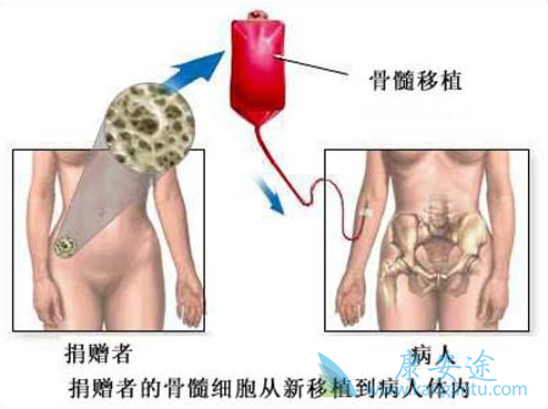 白血病骨髓移植 白血病骨髓移植