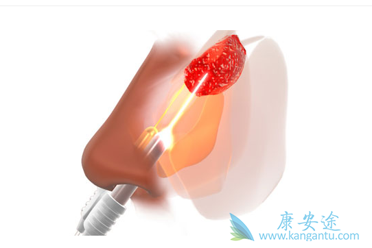 鼻咽癌治疗 鼻咽癌治疗