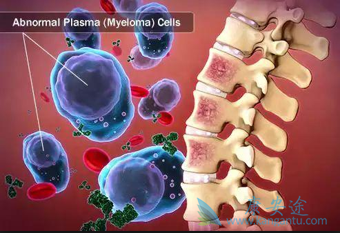 多发性骨髓瘤 多发性骨髓瘤