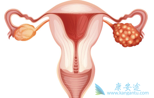 卵巢癌 卵巢癌