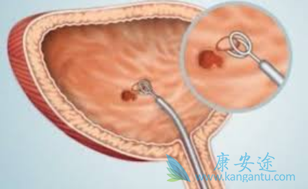 膀胱癌的早期症状 膀胱癌的早期症状