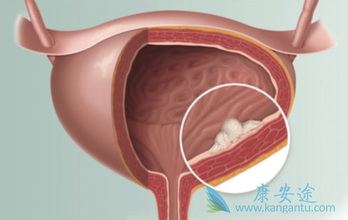 膀胱癌的早期症状 膀胱癌的早期症状