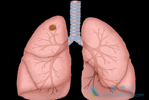 肺癌晚期吃什么好 肺癌晚期吃什么好