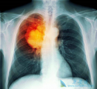 ���ڷΰ����߳�EGFR-TKI����������ָζ��Ե�ԭ����ʲô��