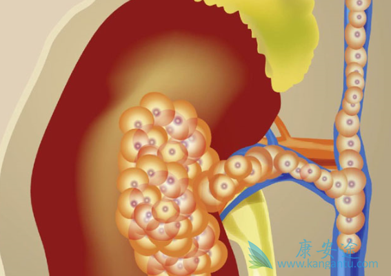 晚期肾癌 晚期肾癌