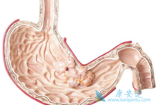 胃癌能活多久 胃癌能活多久