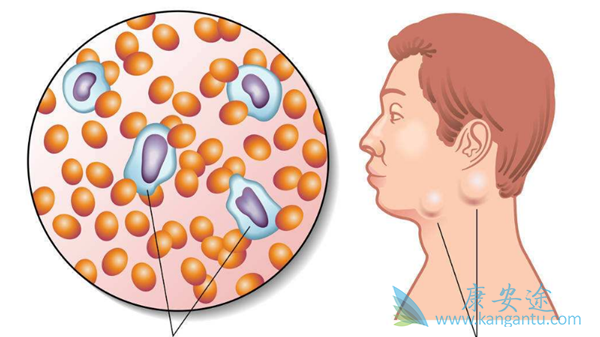 非霍奇金淋巴瘤 非霍奇金淋巴瘤