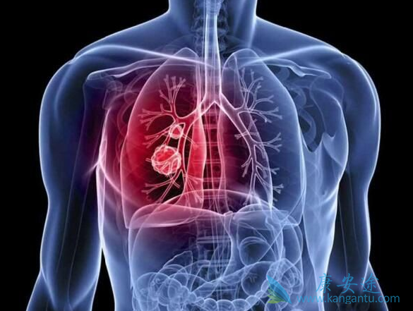 非小细胞肺癌 非小细胞肺癌