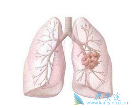 非小细胞肺癌 非小细胞肺癌