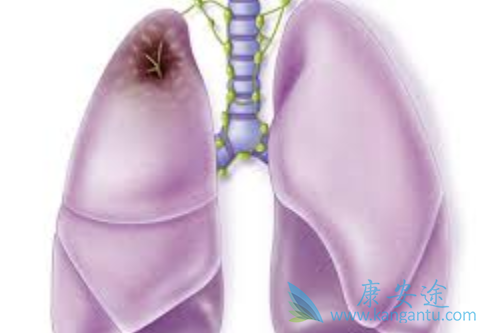 非小细胞肺癌 非小细胞肺癌