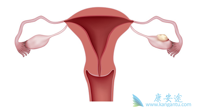卵巢癌分期 卵巢癌分期