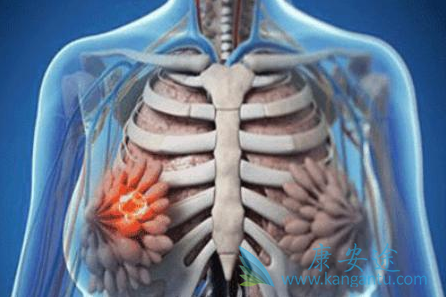乳腺癌复发 乳腺癌复发