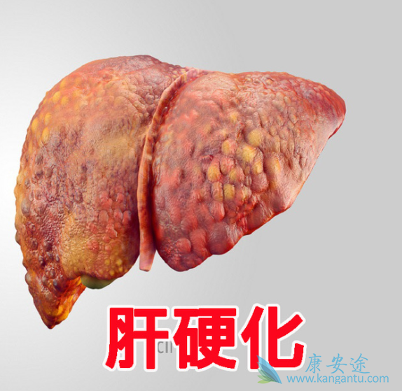 肝硬化治疗 肝硬化治疗