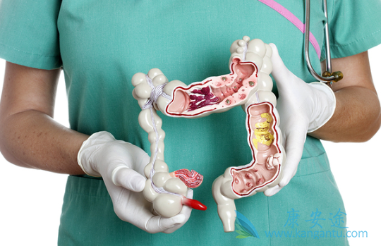 结直肠癌 结直肠癌