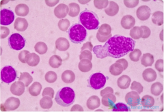 ��Ѫ����Ⱦ�𣿰�Ѫ��������֢״����Щ��