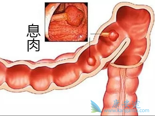 结直肠癌 结直肠癌